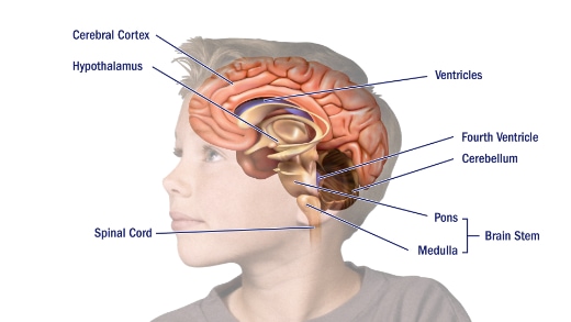 Pontine tumors are found in the pons of the brainstem